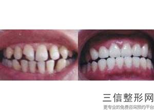 正畸牙齿很大年龄是多少(正畸牙齿很大年龄是多少岁)