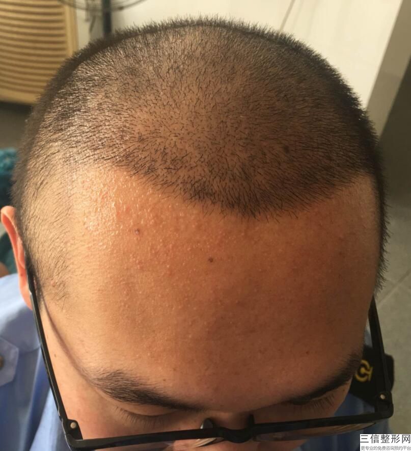 植发需要自己的毛发移植吗(植发需要自己的毛发移植吗多少钱)