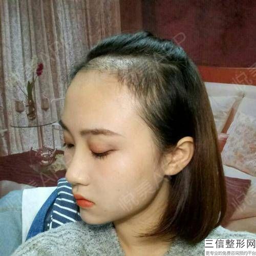 种植发际线脱落期掉多少(种植发际线脱落期掉多少根头发)