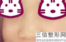 做假体隆鼻一般要多少钱(做假体隆鼻一般要多少钱)