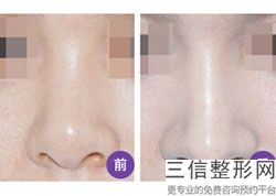 做隆鼻手术哪种良好的医院(做隆鼻手术哪种良好的医院比较安全)