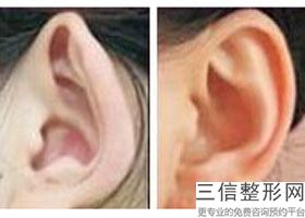 12岁招风耳怎么矫正