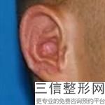2022-2023北京招风耳矫正今年多少钱