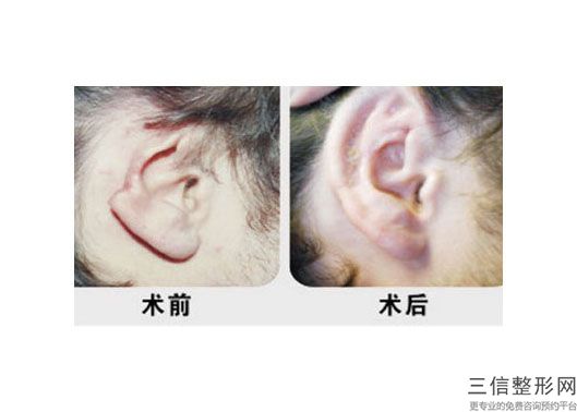 2022-2023郑州华山整形医院医院招风耳矫正价格是多少