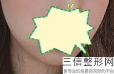 2023-2024洛阳玻尿酸丰唇医院哪家医生厉害