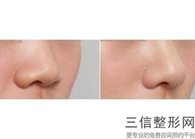 2023上海玻尿酸注射鼻子医院哪家正规