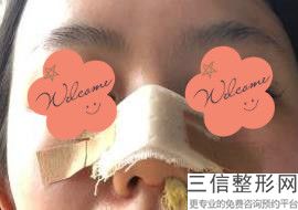 鼻子修复多少钱一次合适