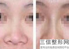 鼻子修复率很高怎么办呢