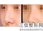 鼻子修复是重新做吗多少钱