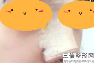 鼻综合手术多少钱左右