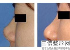 鼻综合要多久消肿掉