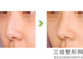 鼻综合整形价格