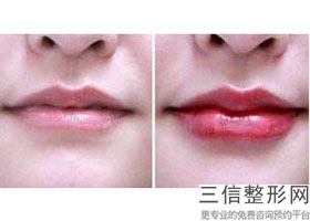 玻尿酸丰唇安全可靠吗多少钱