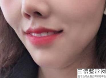 玻尿酸丰唇吃饭被热气熏了一下