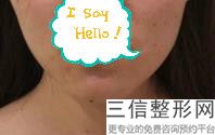 玻尿酸丰唇能保持多长时间