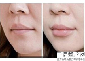 玻尿酸丰唇能维持多久价格
