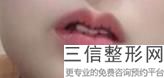 玻尿酸丰唇痛感如何