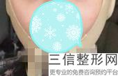玻尿酸丰唇形状