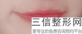 玻尿酸丰唇要打几次