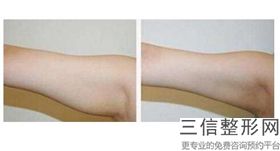 玻尿酸丰胸需要多少钱一次