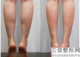 玻尿酸丰胸怎么样能维持久一点呢