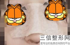 玻尿酸隆鼻失败案例多吗