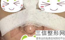 玻尿酸隆鼻一般多少钱