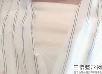 哺乳期可以做假体隆胸吗