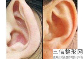 成人招风耳矫正手术