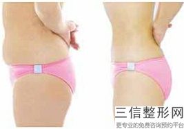 抽脂丰胸大概价格多少
