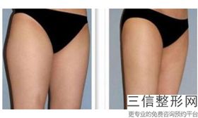 抽脂丰胸效果怎么样啊多少钱