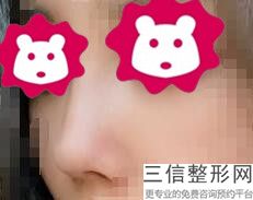 纯硅胶隆鼻的效果