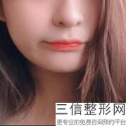 打玻尿酸丰唇能保持多久
