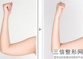 打玻尿酸丰胸