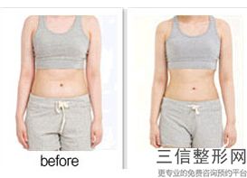大腿抽脂多久出效果