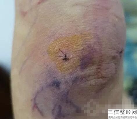 大腿抽脂多久消肿不痛不痒
