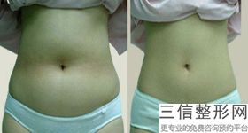 大腿抽脂肪手术过程多久出院好