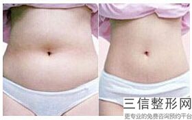 大腿抽脂手术过程