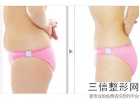 大腿抽脂一次多少钱啊