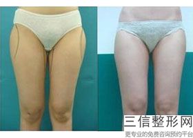 大腿环吸是什么样子的