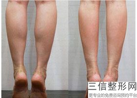 大腿局部吸脂和环吸哪个好些呢