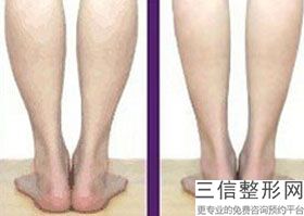 大腿吸脂多久可以消肿掉啊