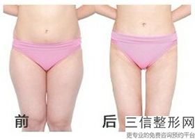 大腿吸脂多久走路不痛了