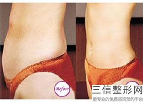 大腿吸脂坏处有哪些