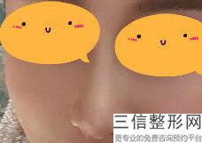 垫鼻子是用什么垫的
