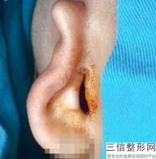 耳软骨假体隆鼻