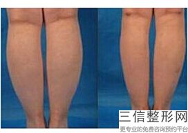 丰胸哪里有