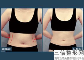 给大腿抽脂有什么危害嘛女生