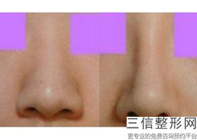 硅胶假体隆鼻可以维持几年吗