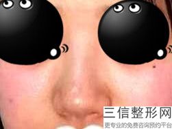 硅胶隆鼻效果能维持多久